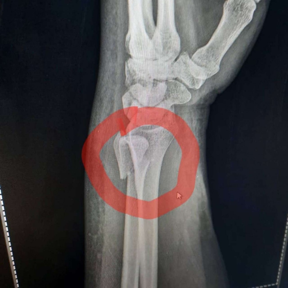 Azərbaycanlı aparıcının biləyi qırıldı -FOTOLAR