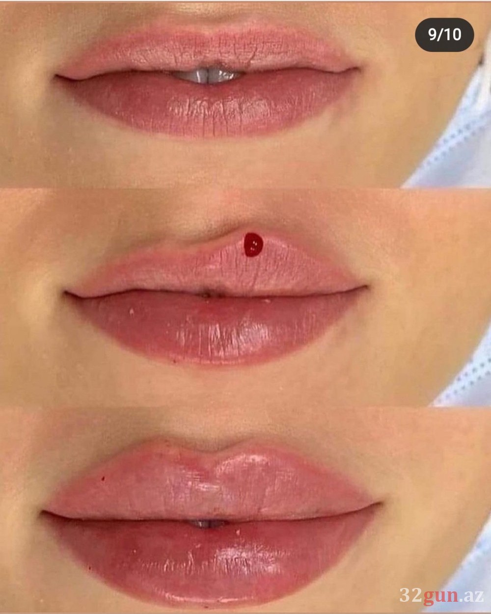 Xəstələrinin dodaqlarını cürüdən kosmetoloq yenidən fəaliyyətə başladı -Onu Qənirə Paşayeva ilə nə bağlayır? (FOTO)