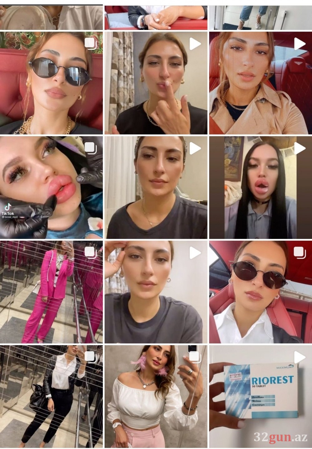 Xəstələrinin dodaqlarını cürüdən kosmetoloq yenidən fəaliyyətə başladı -Onu Qənirə Paşayeva ilə nə bağlayır? (FOTO)