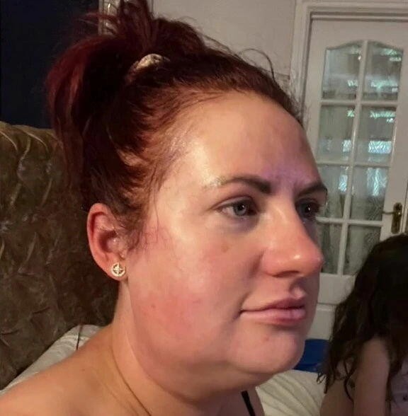 Buxağını kiçiltmək istədi, üzü dörd dəfə böyüdü- FOTOLAR