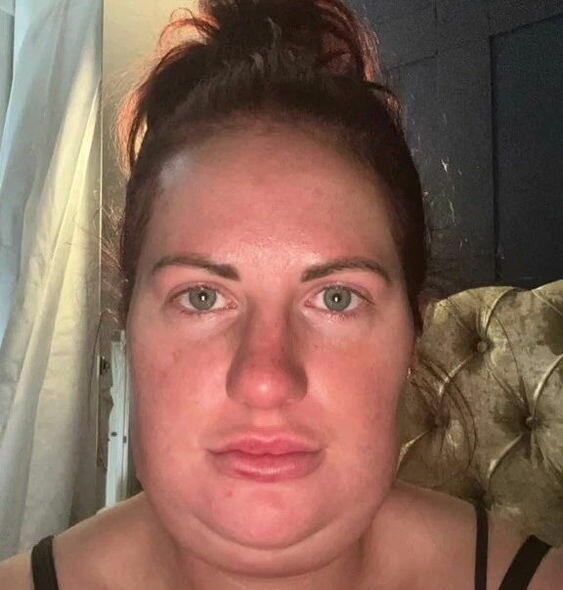 Buxağını kiçiltmək istədi, üzü dörd dəfə böyüdü- FOTOLAR