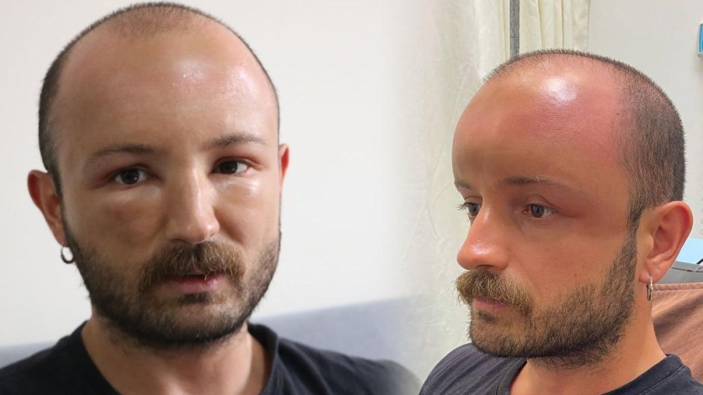 Çimərliyə gedən kişi dəhşətli xəstəlik tapdı- Ürəyi zəif olanlar baxmasın (FOTO)