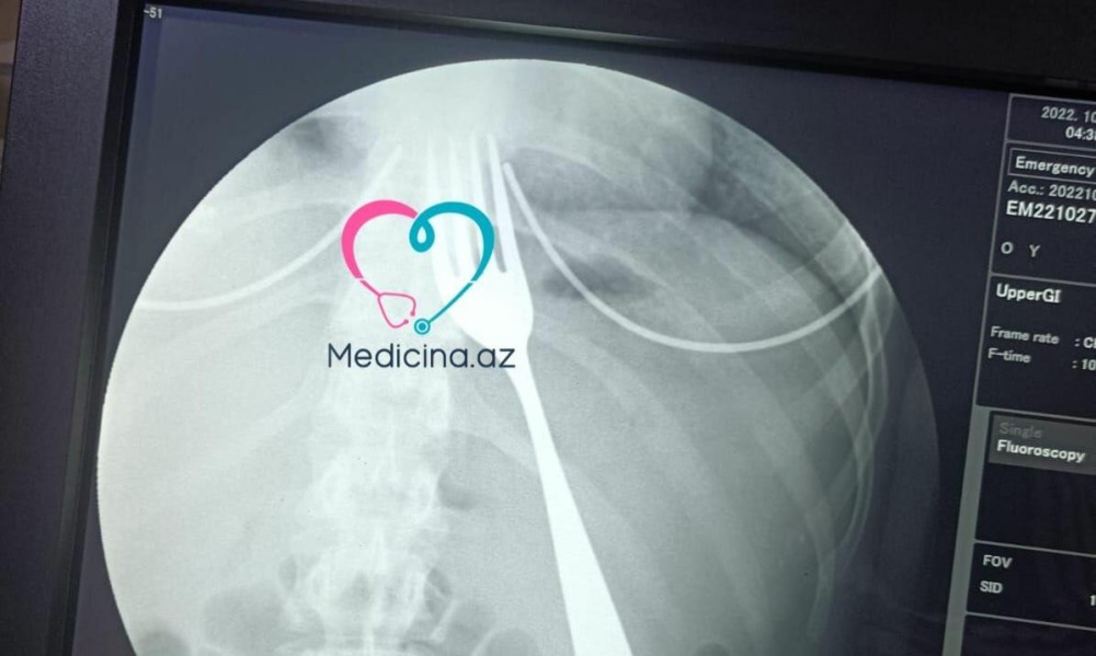 Bakıda şok olay- 21 yaşlı qız çəngəl uddu (FOTO)