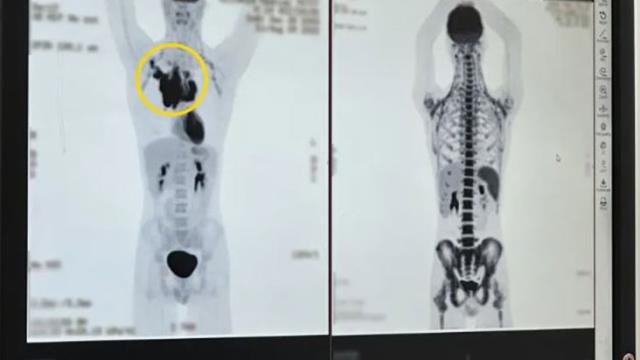 İdman edərkən çiynindən gələn səsə görəhəkimə getdi -  Eşitdiklərindən şoka düşdü