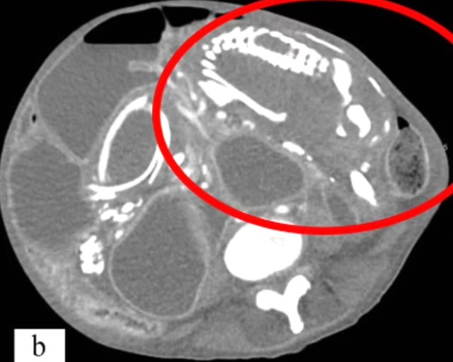 Şiddətli qarın ağrısı ilə həkimə gedən 50 yaşlı qadındünyasını dəyişdi - SƏBƏB