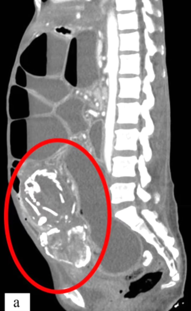 Şiddətli qarın ağrısı ilə həkimə gedən 50 yaşlı qadındünyasını dəyişdi - SƏBƏB
