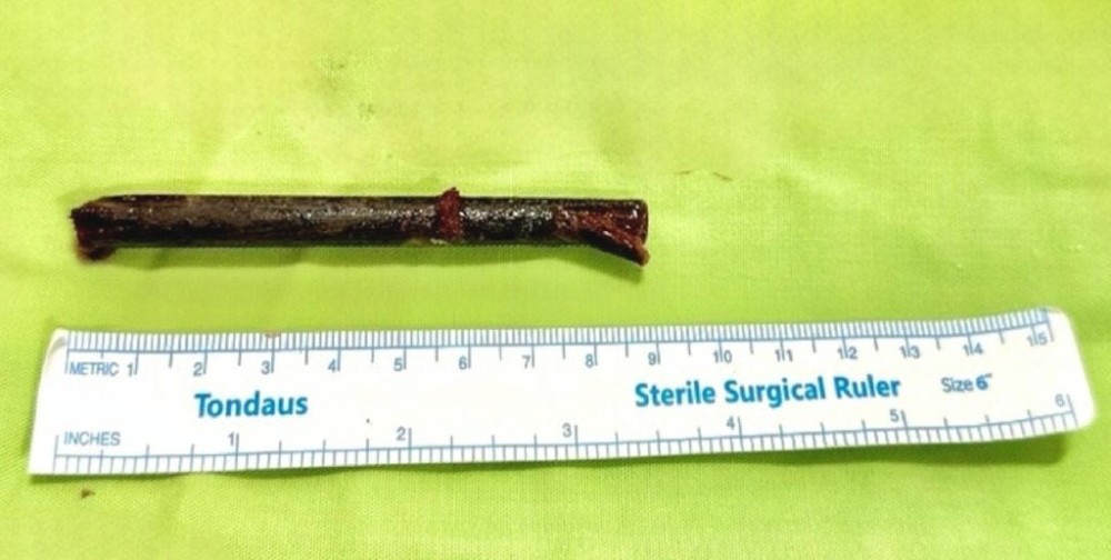 Vyetnamda kişinin göz yuvasından 3 həftə sonra yemək çubuğu çıxarıldı