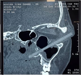 Vyetnamda kişinin göz yuvasından 3 həftə sonra yemək çubuğu çıxarıldı
