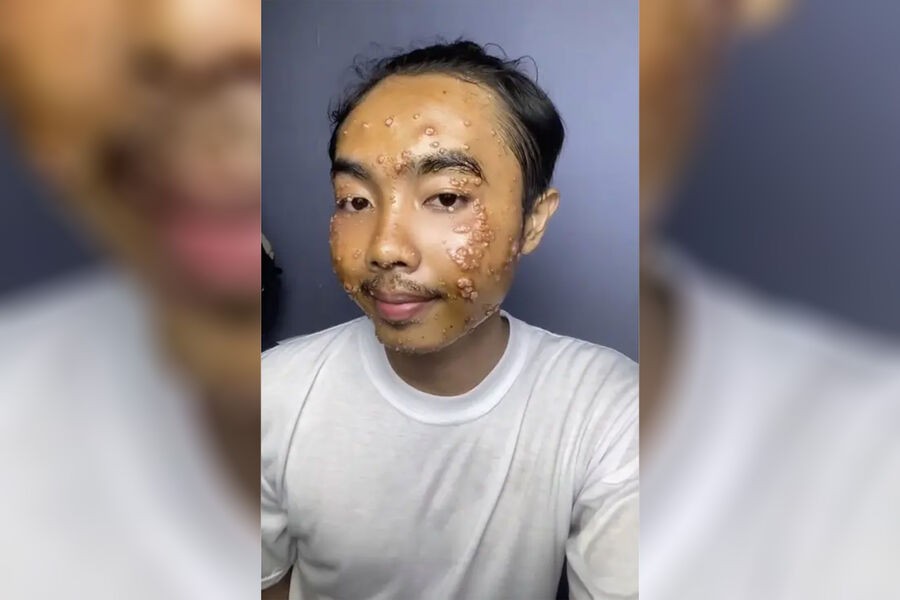 Kişi ikinci əl geyim səbəbilə dəri xəstəliyinə tutuldu+ FOTO