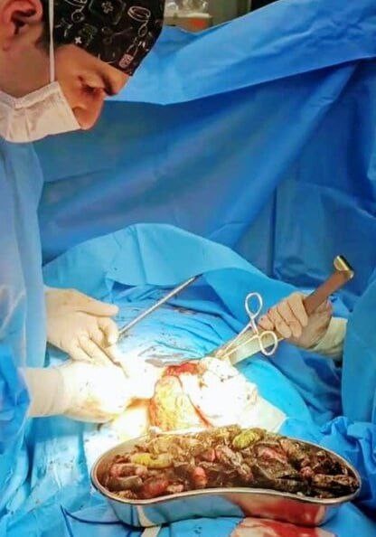 İranda ŞOK: qarnından90 narkotik paketi çıxdı